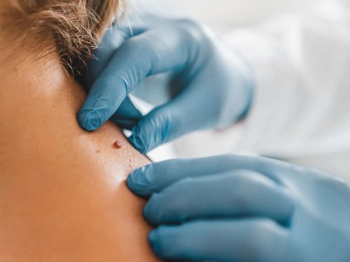 Skin Tag Removal