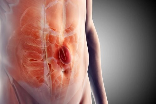 Incisional Hernia